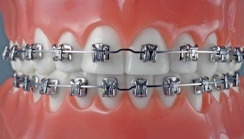 用于容纳和固定牙齿矫正的钢丝,通过粘接剂将其粘接在牙齿表面使牙齿