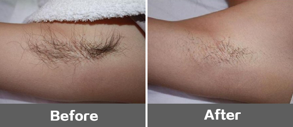 武汉脱毛 服务详情 激光穿透至真皮的深层以及皮下脂肪组织,作用于不