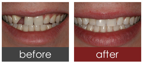 牙齿缺损不美观 仿生种植牙来帮你修复
