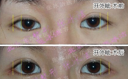 眼角区别于一般的外眼角开大术,张氏开大外眼角术根据眼部解剖的结构
