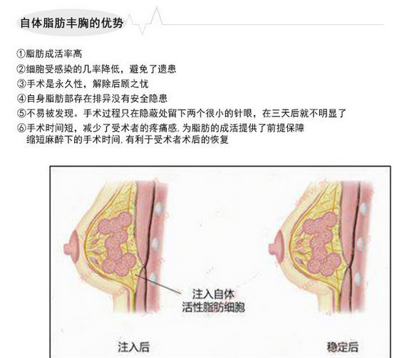 手术将丰胸者自身的多余脂肪用细针吸出,特别活化处理成纯净脂肪颗粒