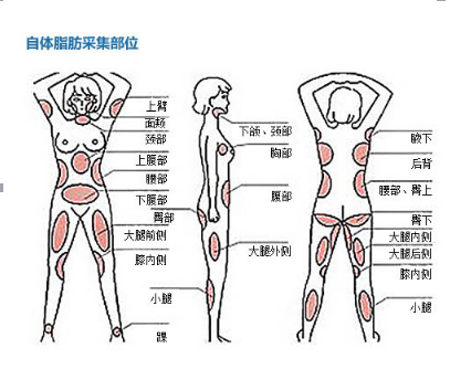 脂肪面部填充  自体脂肪填充脸部,是微创吸脂技术采用细针从身体腰,腹