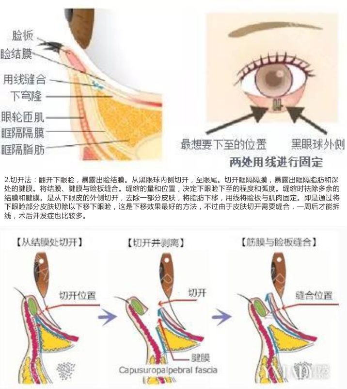 眼睑下至术 开外眼角 营造魅惑无敌性感猫眼