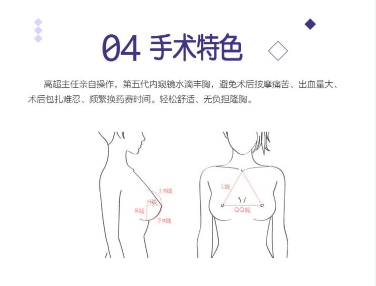 疤痕隐藏 切口位置 一般都选择在腋窝或者乳晕 注射部位 200cc-400cc