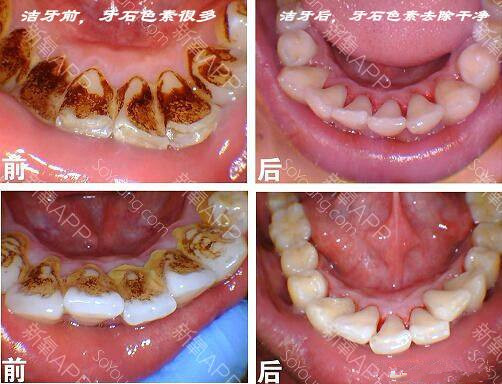 超声波洁牙 清除牙结石 预防口腔疾病