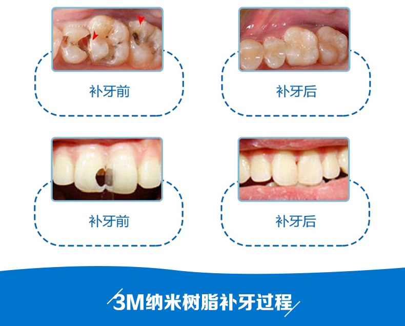 牙齿美容|北京3M纳米树脂补牙套餐 补牙齿牙洞
