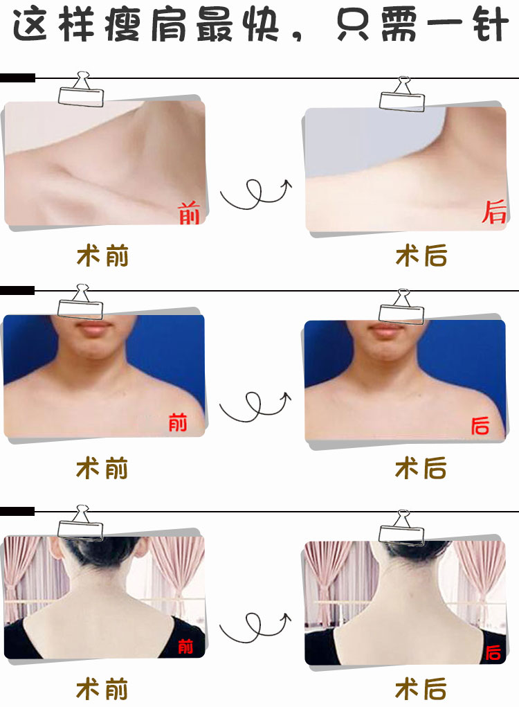 广州衡力瘦肩针 肉素100单位 公立医院 李涛 特惠 一字小香肩 优雅