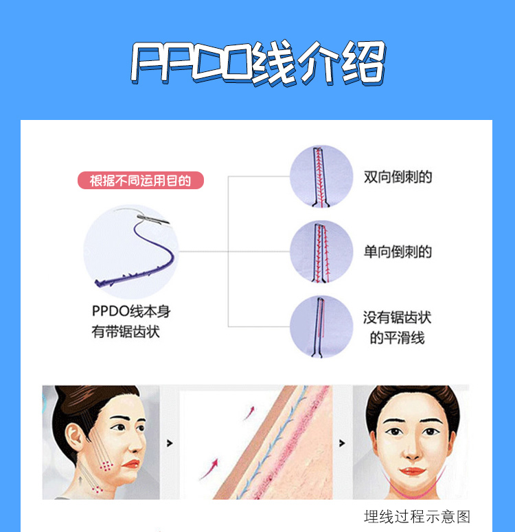 单面部线雕|武汉埋线提升 ppdo蛋白线_悦美整形